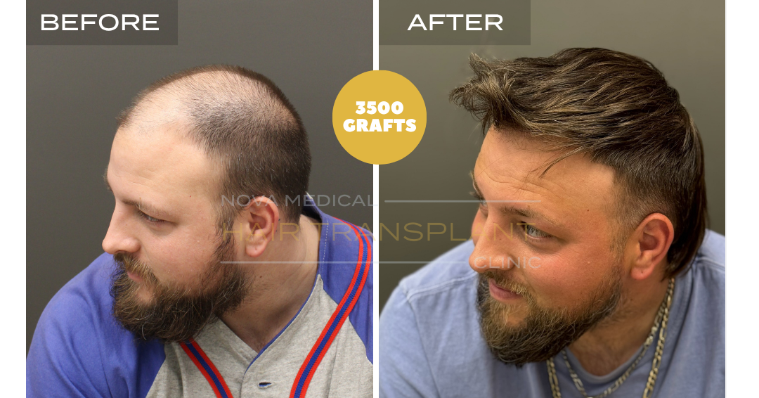 Before and after case 1