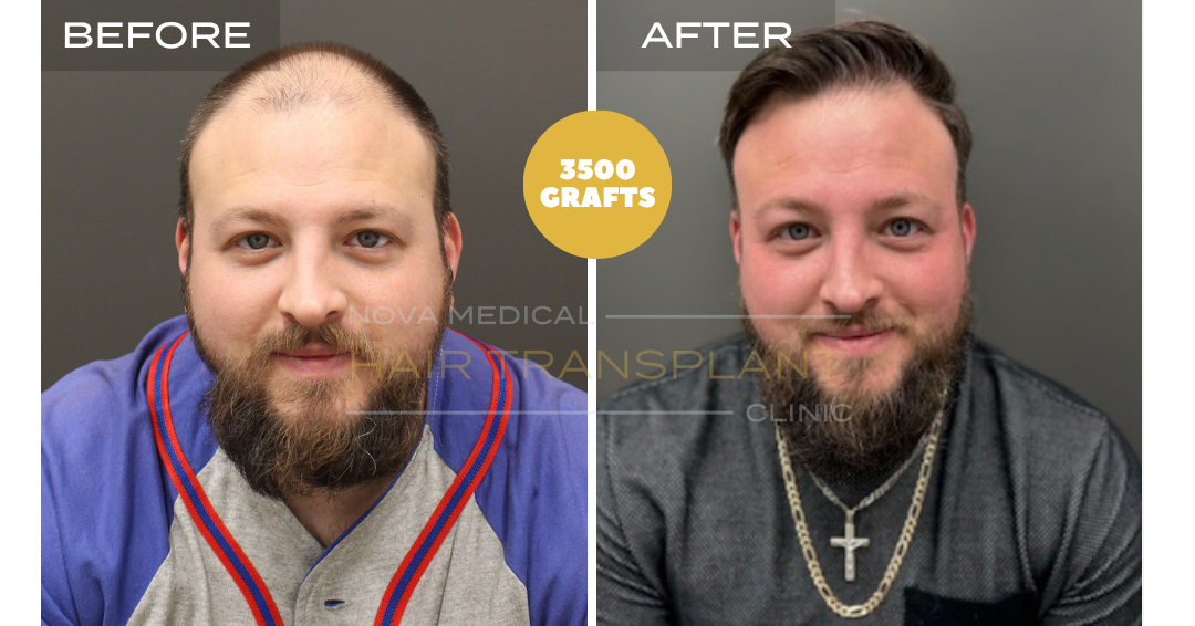 Before and after case 10