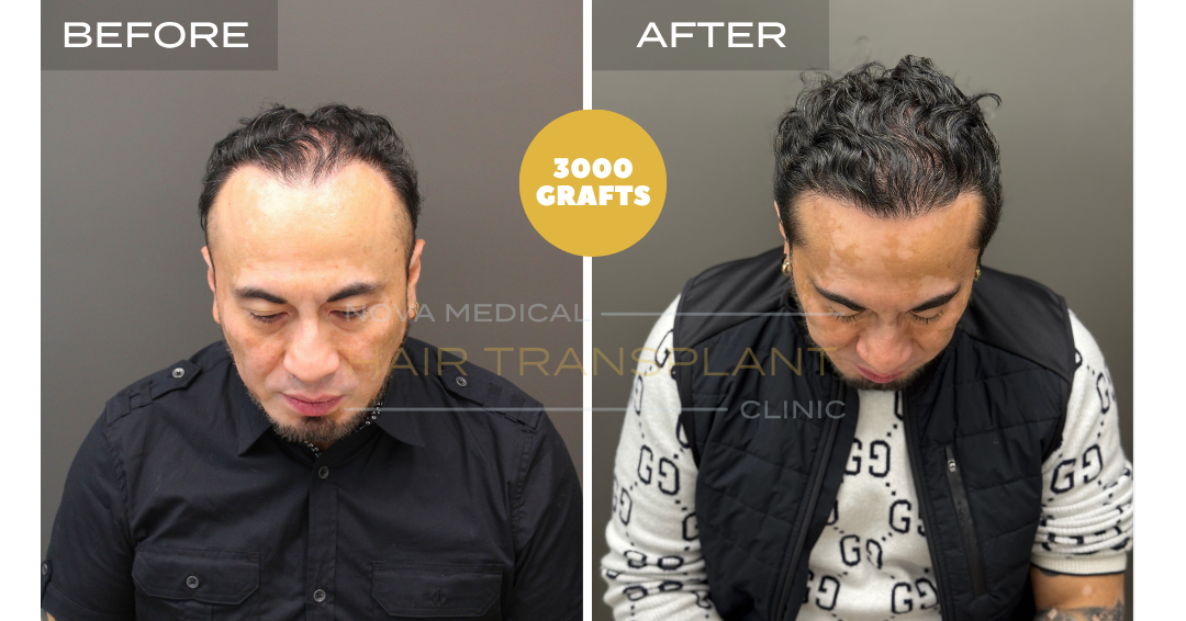 Before and after case 11