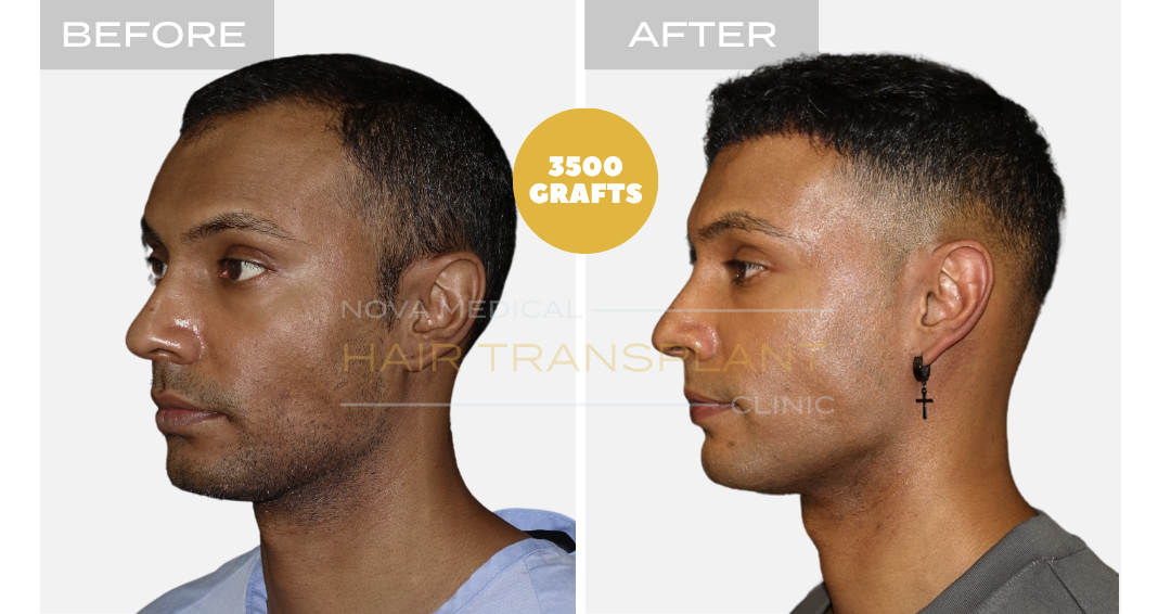 Before and after case 12