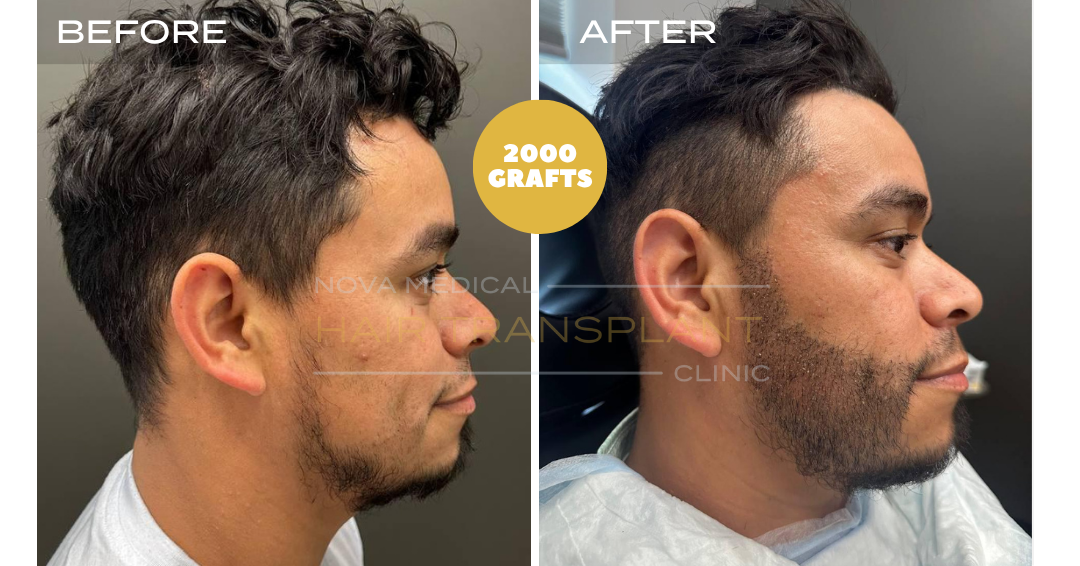 Before and after case 13