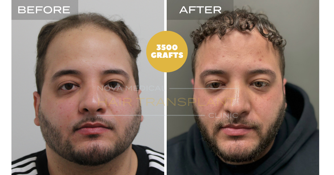 Before and after case 14
