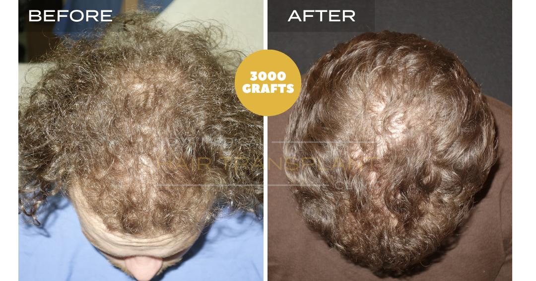 Before and after case 15