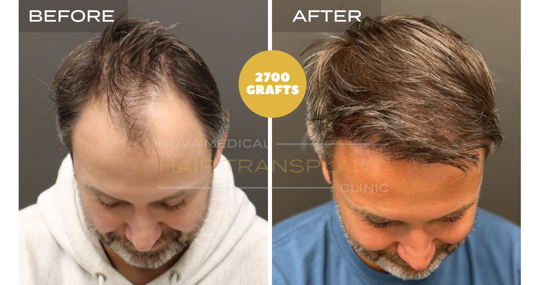 Before and after case 17
