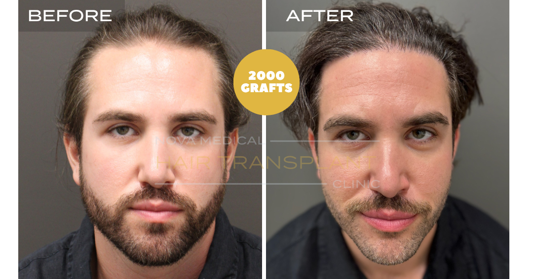 Before and after case 18