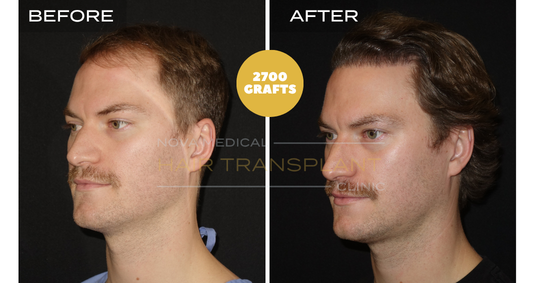 Before and after case 2