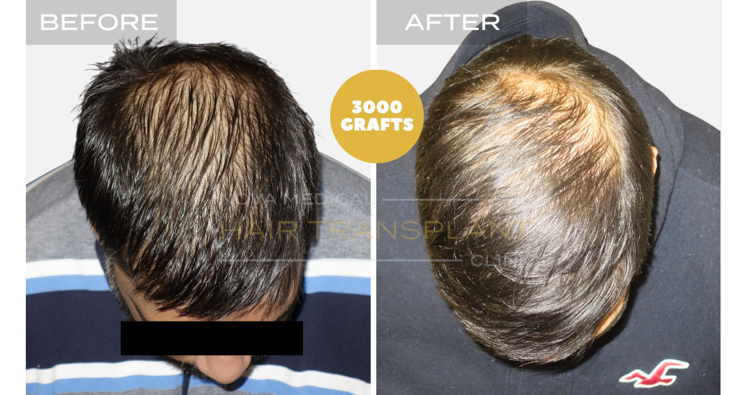 Before and after case 20