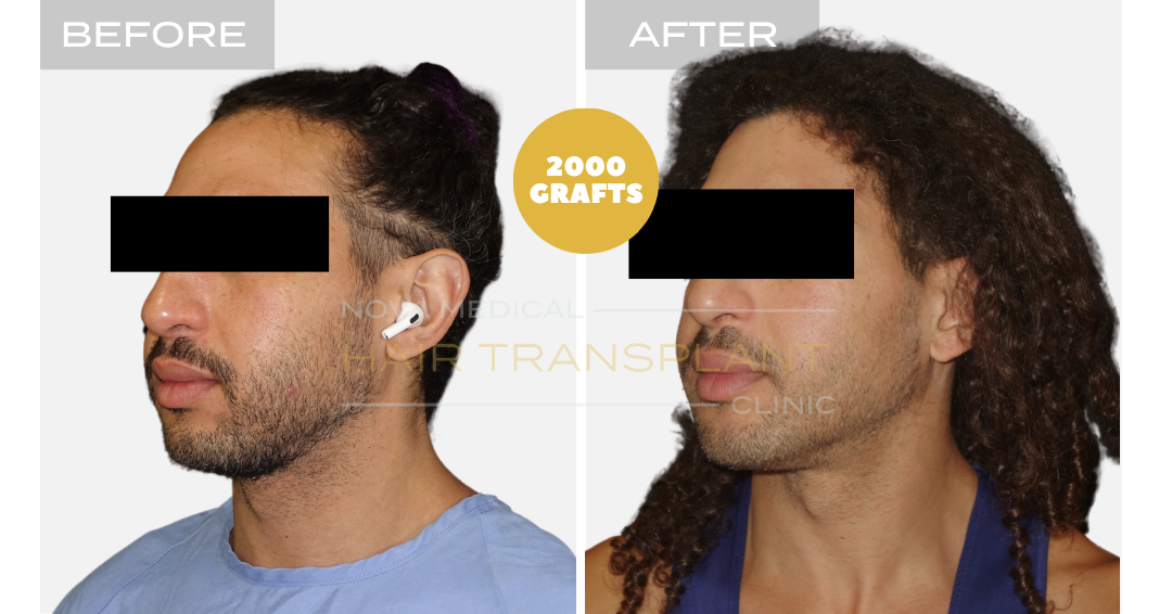 Before and after case 21