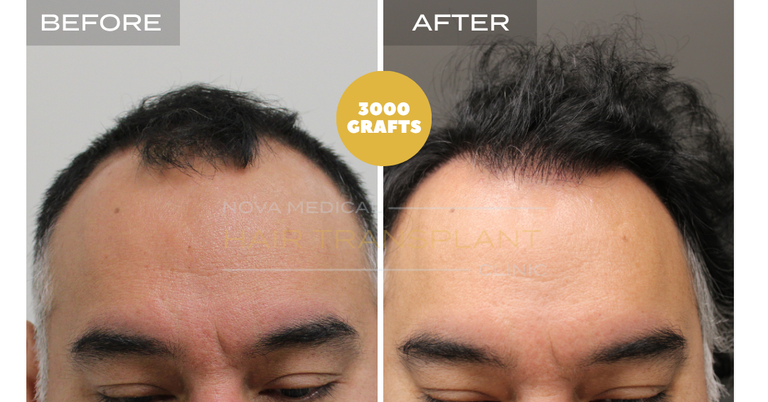 Before and after case 23