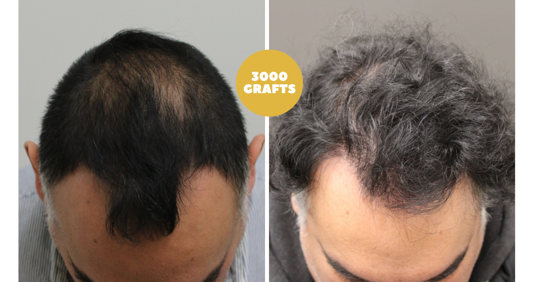 Before and after case 24