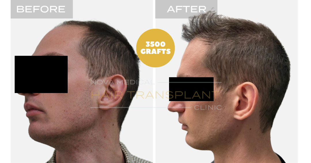 Before and after case 25