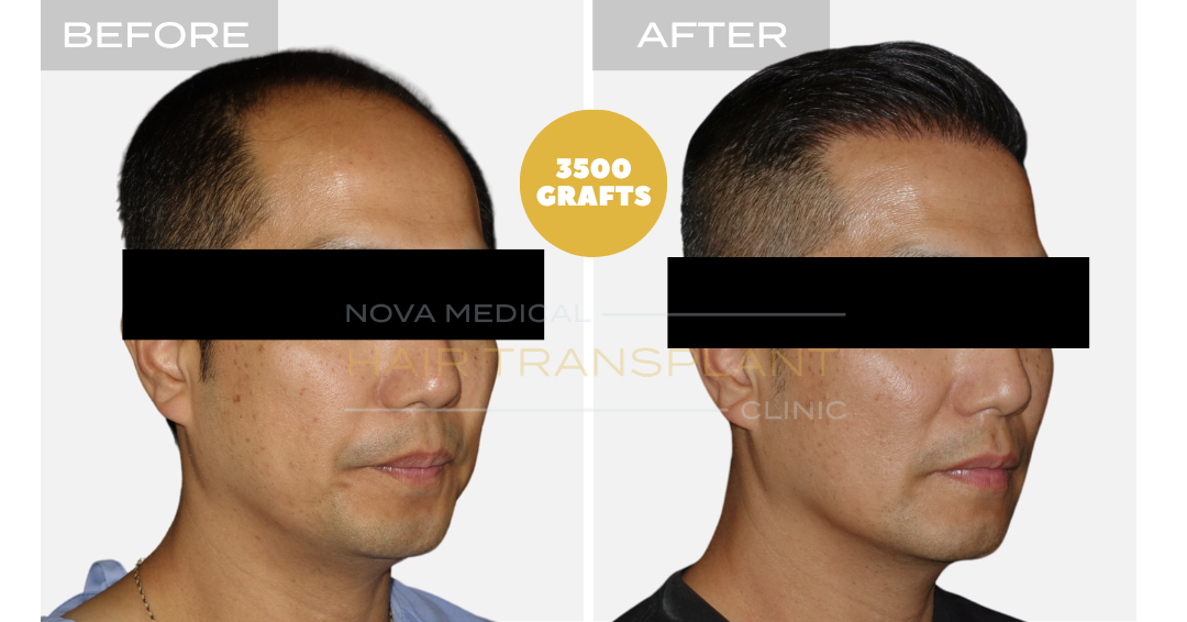 Before and after case 26