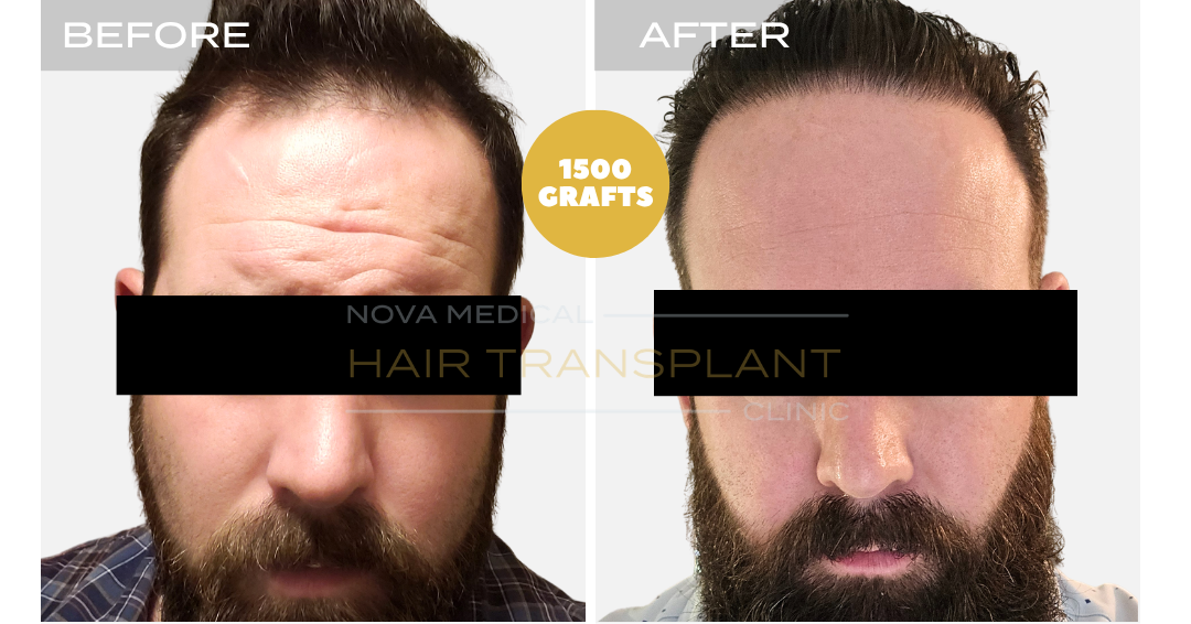 Before and after case 27