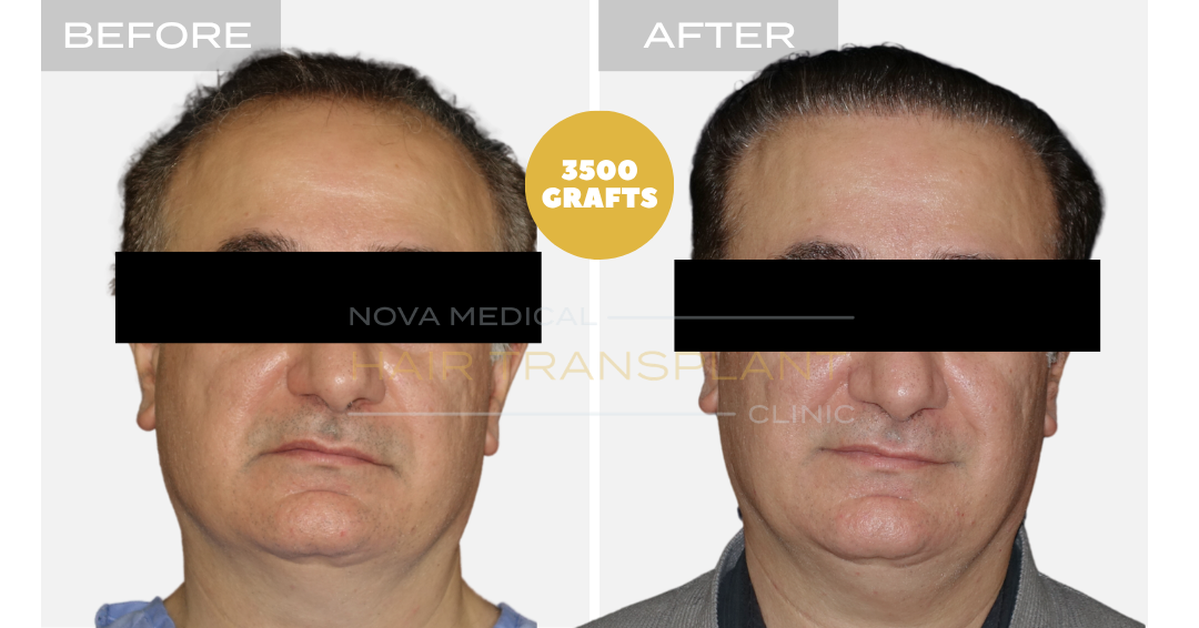 Before and after case 28