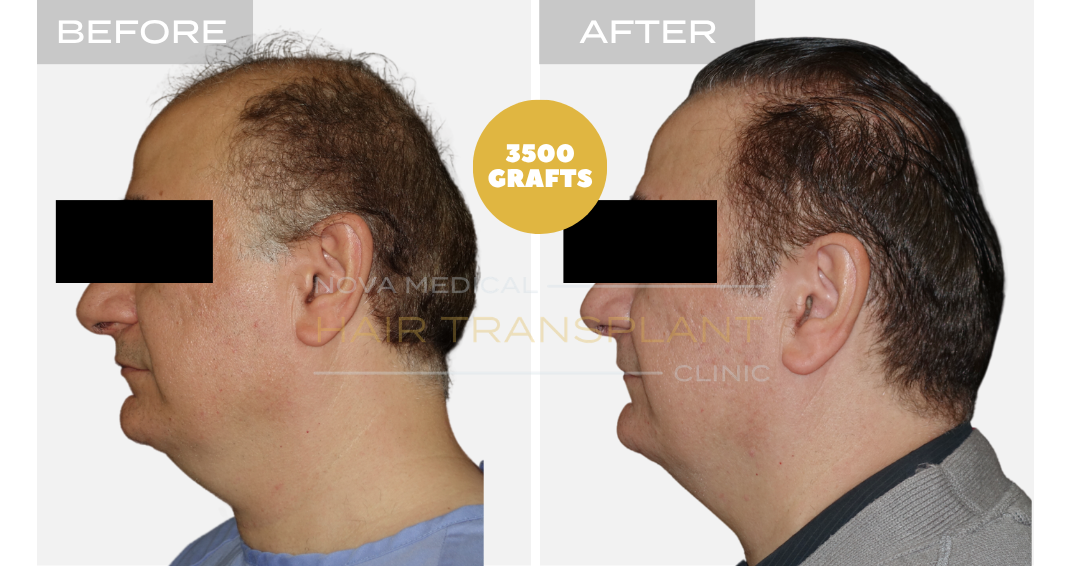 Before and after case 30