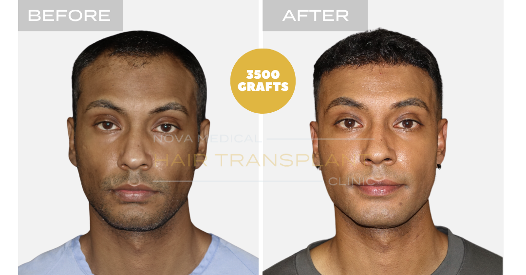 Before and after case 31