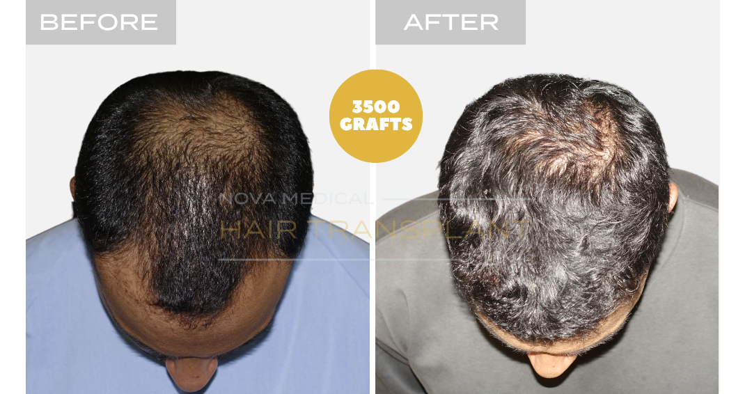 Before and after case 32