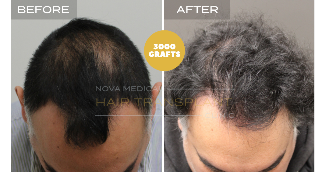 Before and after case 34