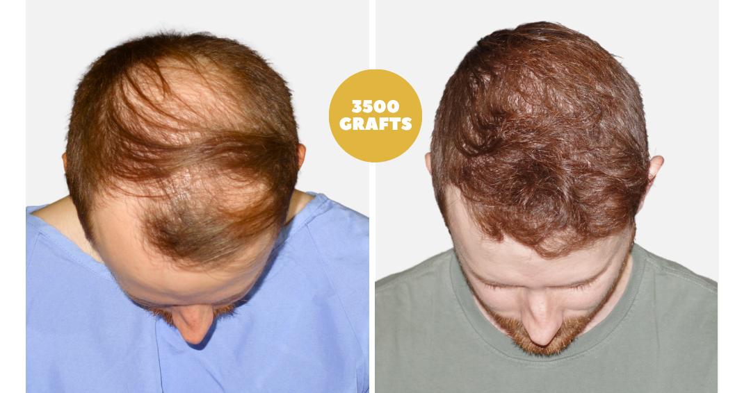 Before and after case 35
