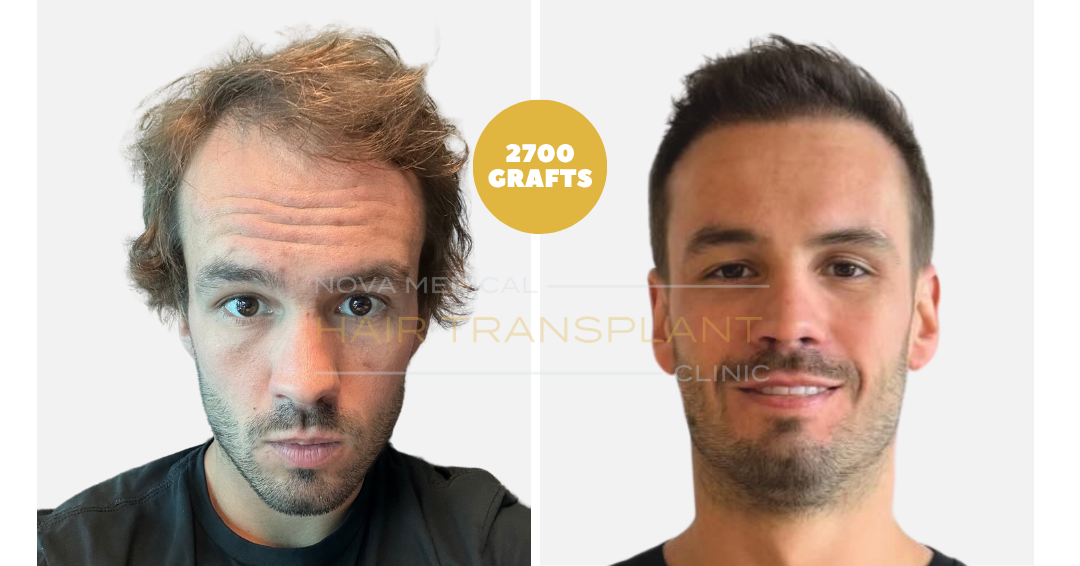 Before and after case 36