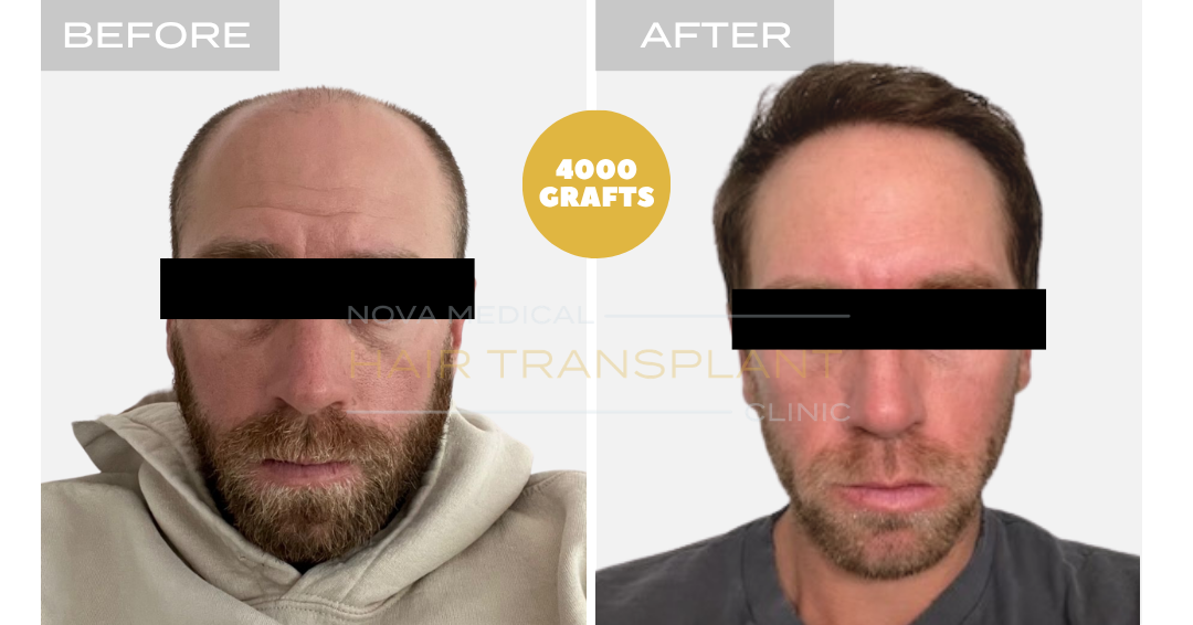 Before and after case 37