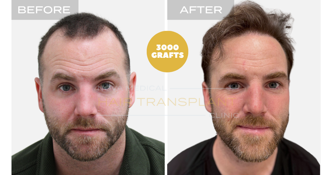 Before and after case 4