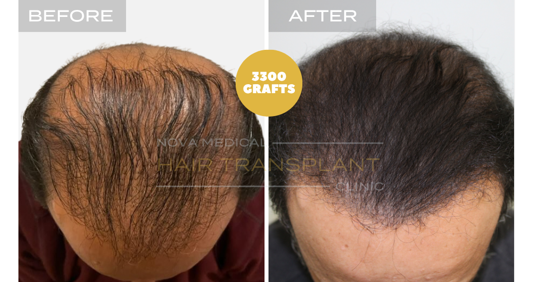 Before and after case 40
