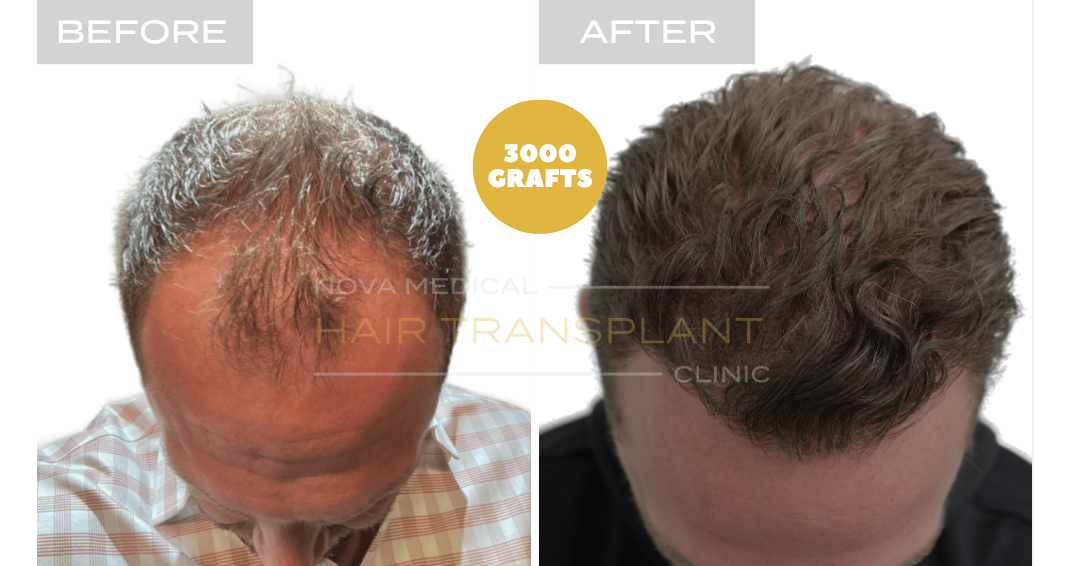 Before and after case 42
