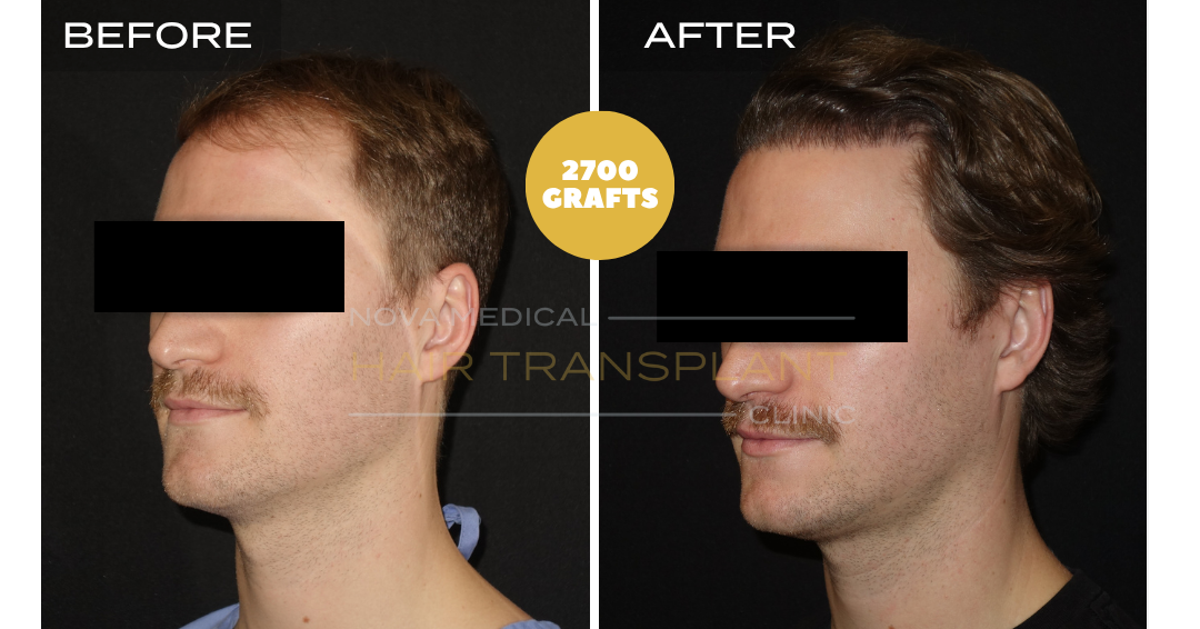 Before and after case 5