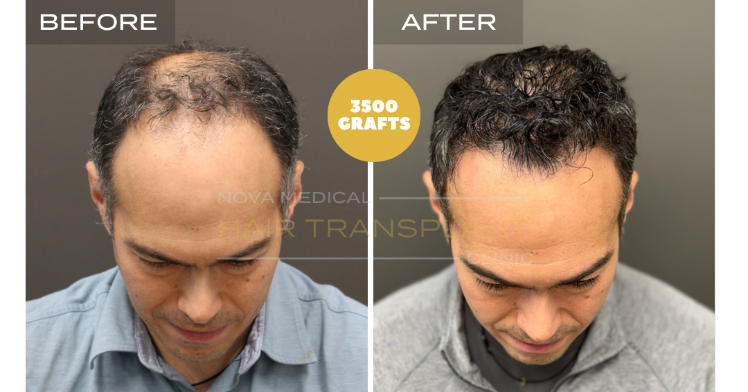Before and after case 6