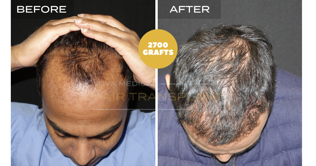 Before and after case 8